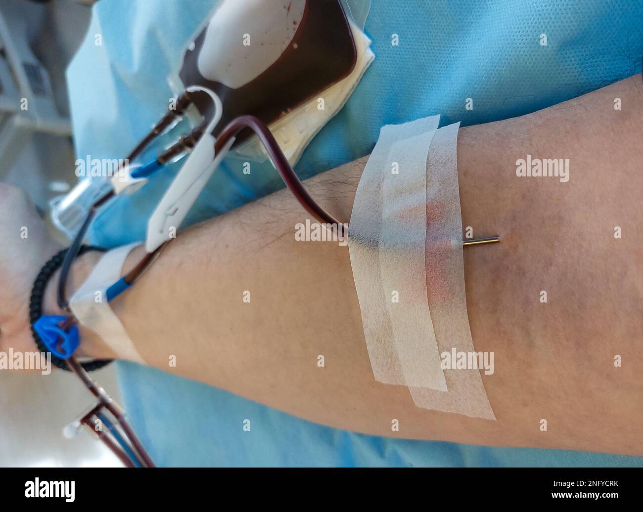 blood donor with big needle stuck in forearm during donation at