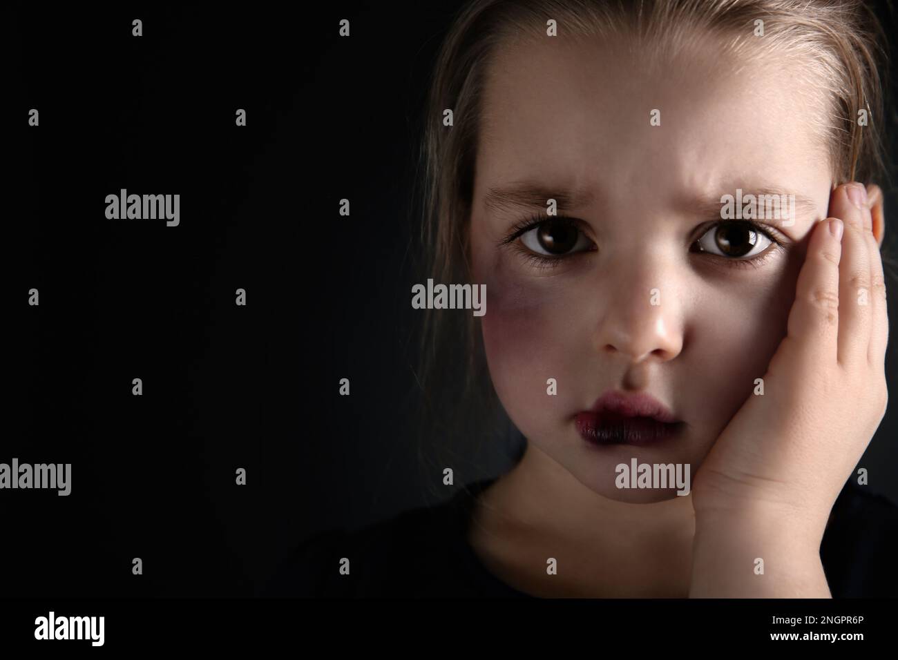 Little girl with bruises on face against dark background, space for ...