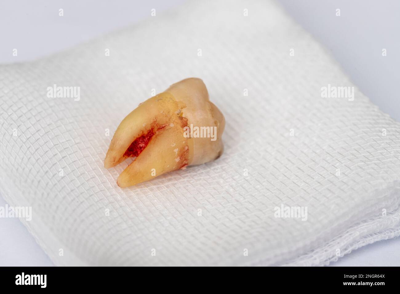 Pulled tooth blood hires stock photography and images Alamy