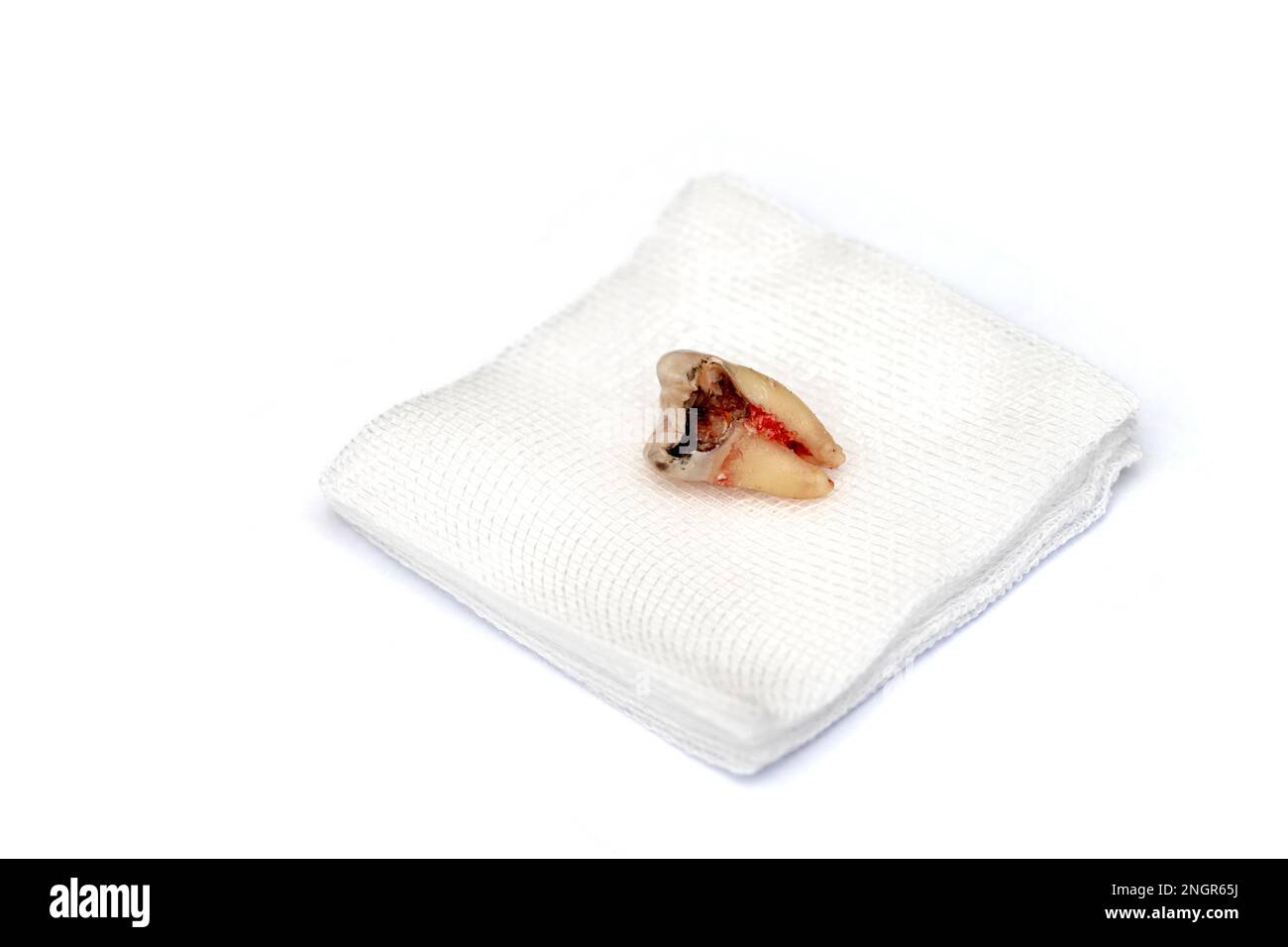 A decayed molar tooth is extracted. The blood hasn't dried yet. Lie down on white gauze