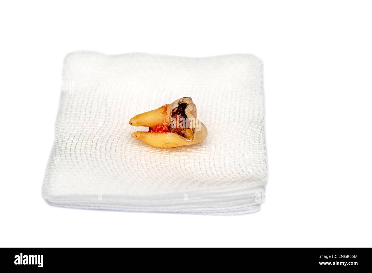 A decayed molar tooth is extracted. The blood hasn't dried yet. Lie