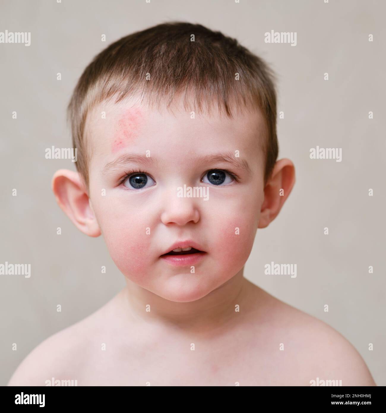 Toddler baby face with scratch on forehead. Portrait of a baby boy with