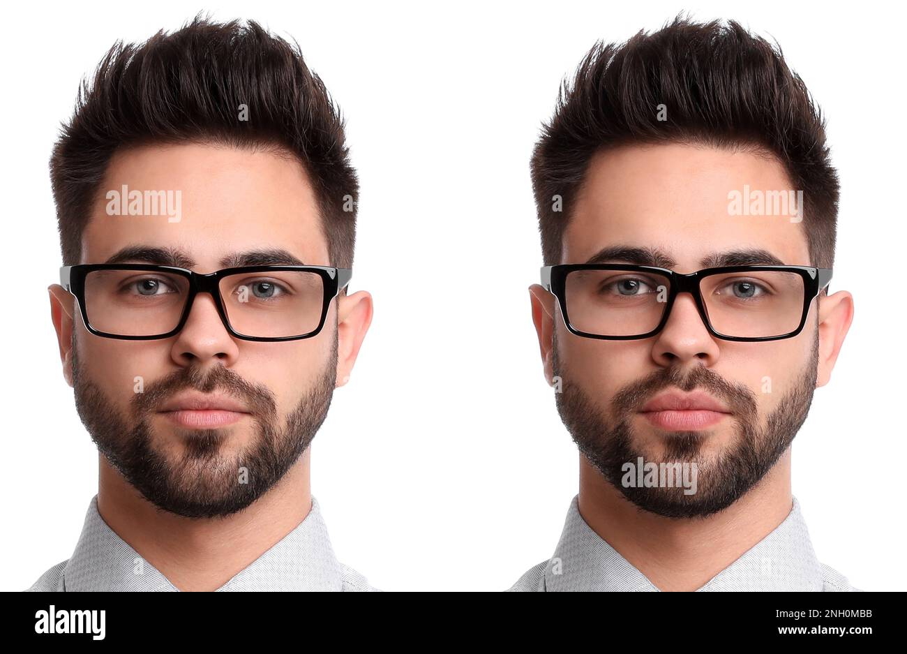 Collage with photos of man before and after lips augmentation on white