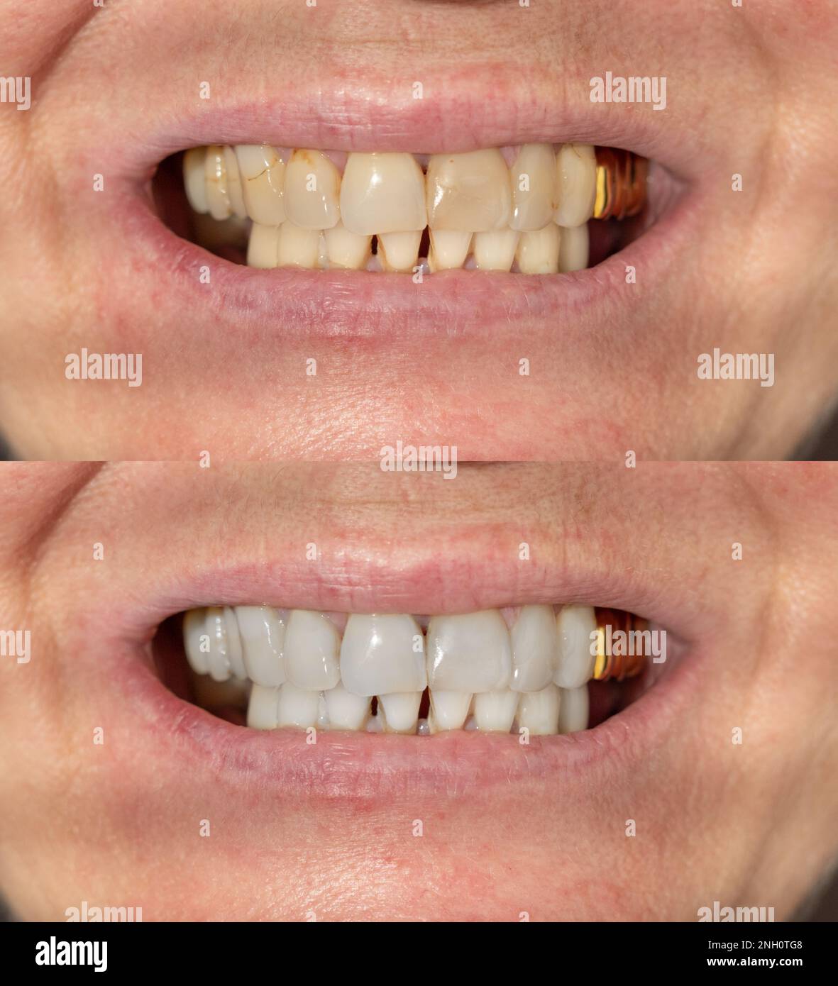 Before and after teeth whitening procedure Stock Photo - Alamy
