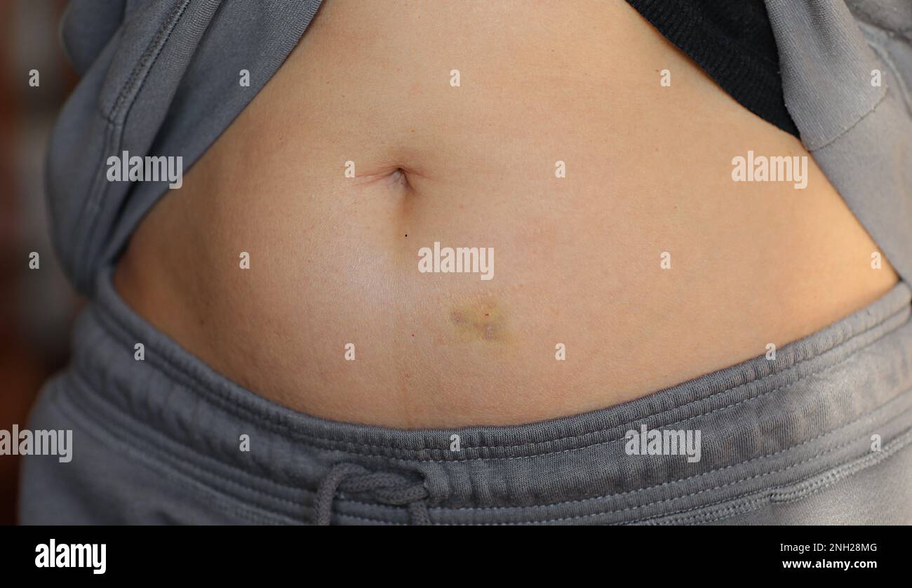 Adult woman with green yellow bruise, hematoma on her stomach at home ...