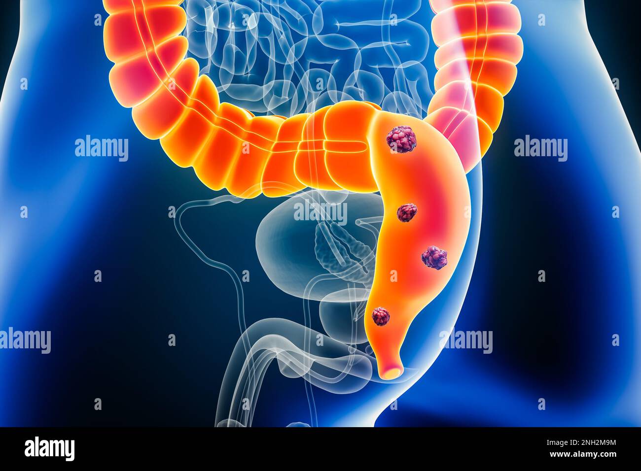 Colorectal cancer xray hires stock photography and images Alamy