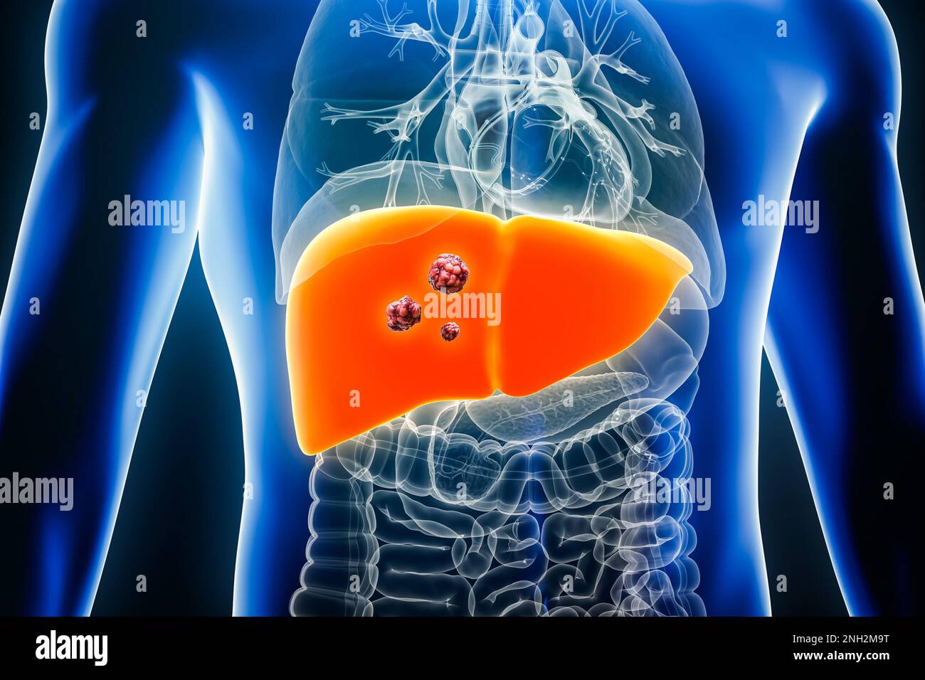Liver cancer with organs and tumors or cancerous cells 3D rendering illustration. Anatomy, oncology, biomedical, disease, medical, biology, science, h Stock Photo