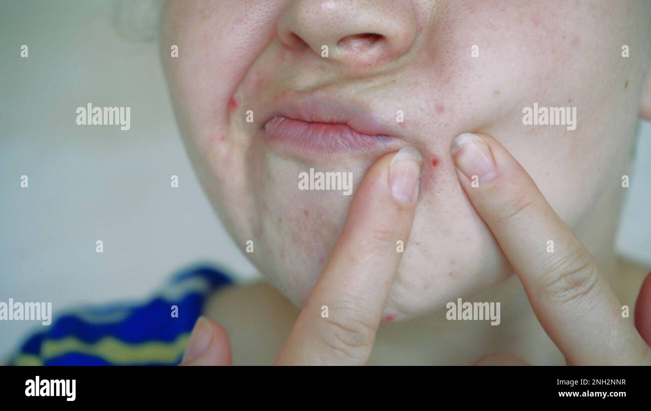 Close up of skin problems, unhealthy skin with acne and pimples. Porous ...