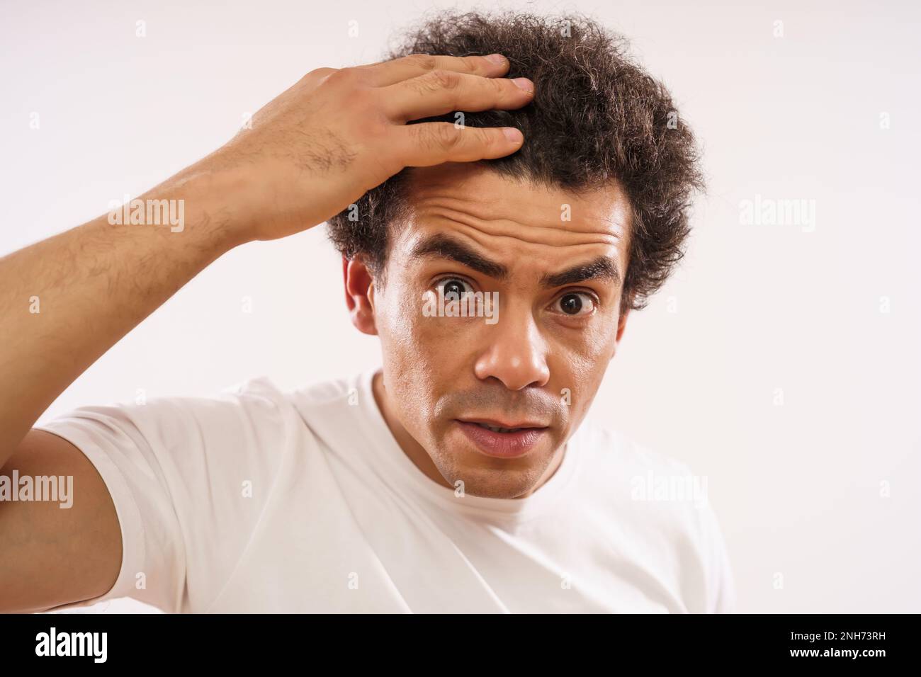 Handsome mixed race adult man is worried because of hair loss. Stock Photo