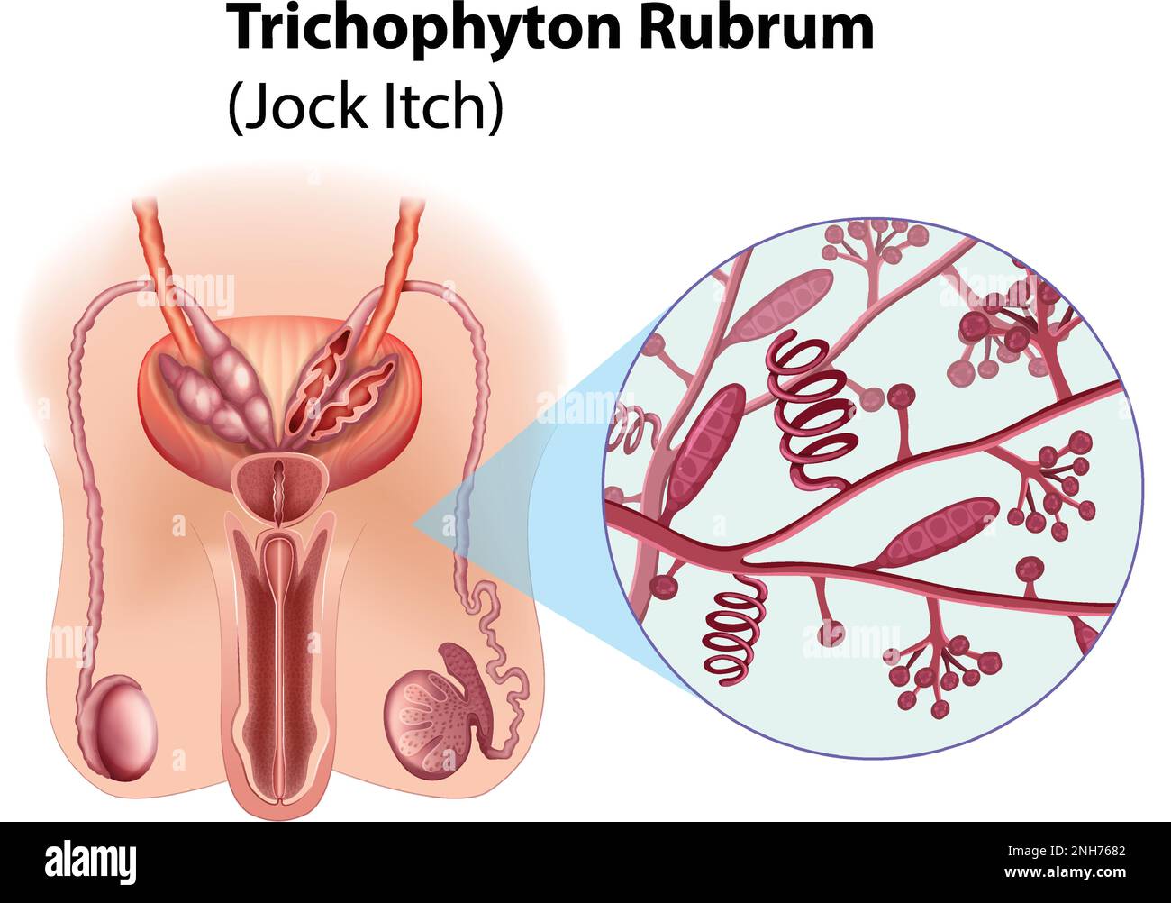 Trichophyton Rubrum fungal infection illustration Stock Vector