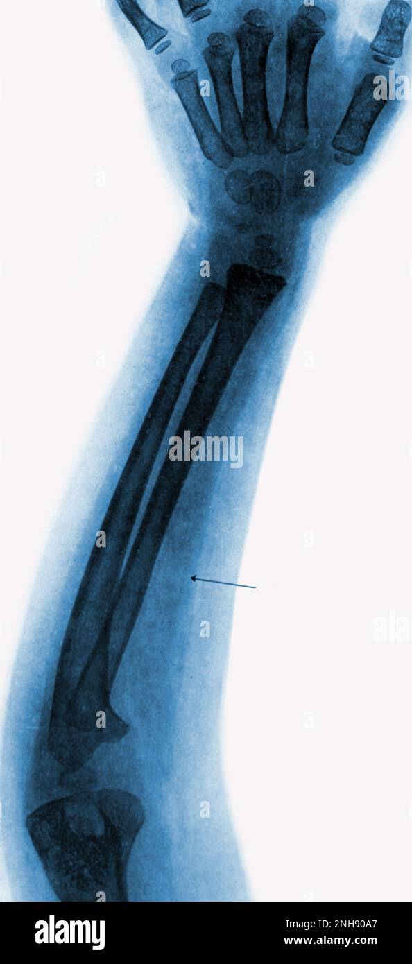 X-ray of the left arm of a 4-year-old child with polio, showing atrophied muscle (see arrow). Colorized. Stock Photo