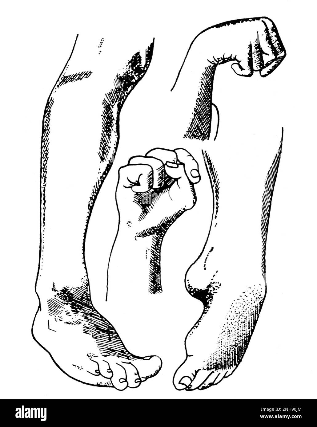Illustration showing the convulsive symptoms of ergot poisoning. Claviceps purpurea (rye ergot fungus) grows on rye and related plants, and produces alkaloids that can cause ergotism in humans and other mammals who consume grains contaminated with its fruiting structure. Illustration by T.O. Heusinger, 1856 Stock Photo