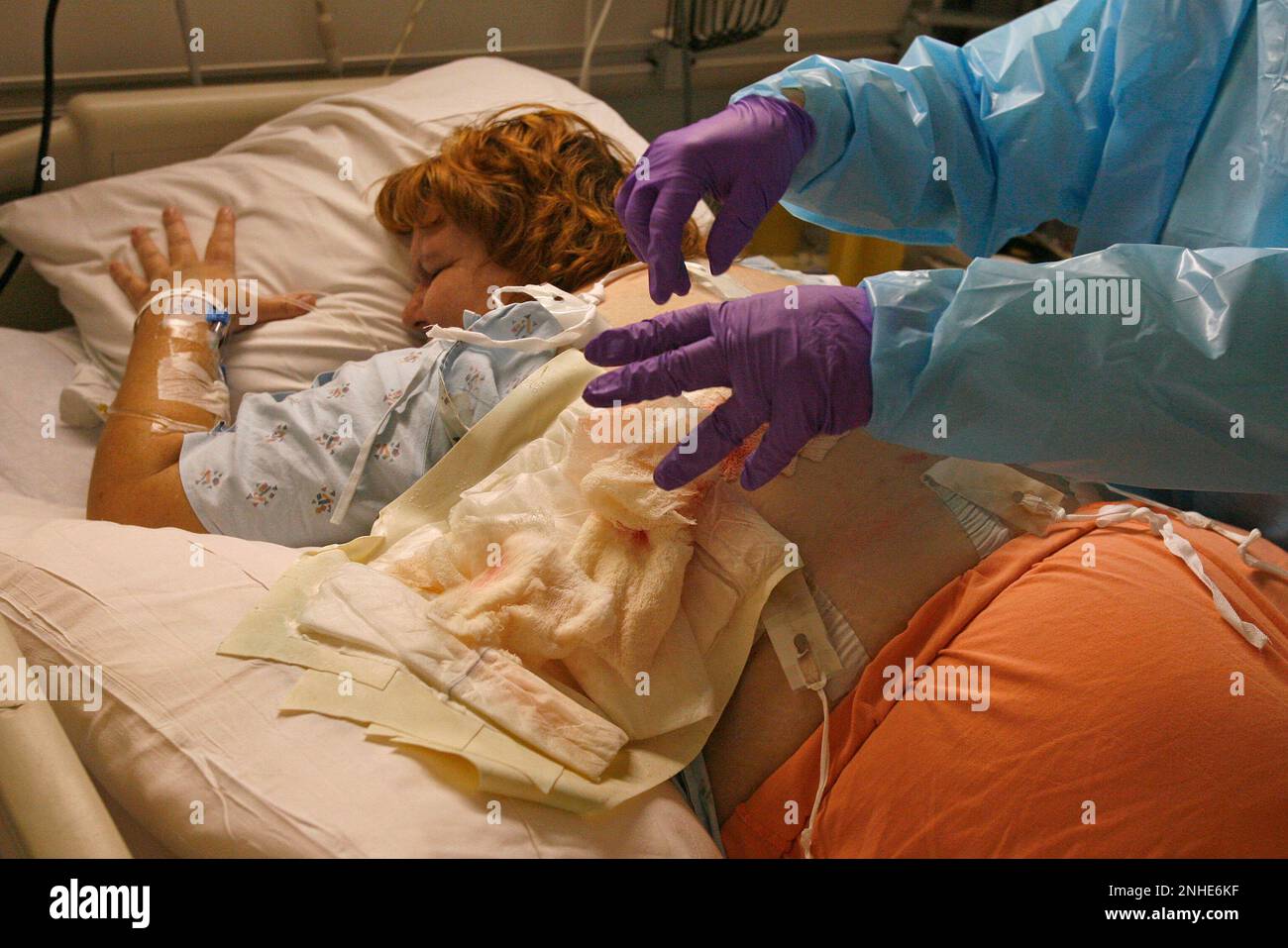 bugs4 139 mac.jpg The surgical dressings are removed for changing and to clean the wound. Two days after surgery to remove a 12 inch by 2 inch section of her skin and bugs4 139 mac.jpg The surgical dressings are removed for changing and to clean the wound. Two days after surgery to remove a 12 inch by 2 inch section of her skin and