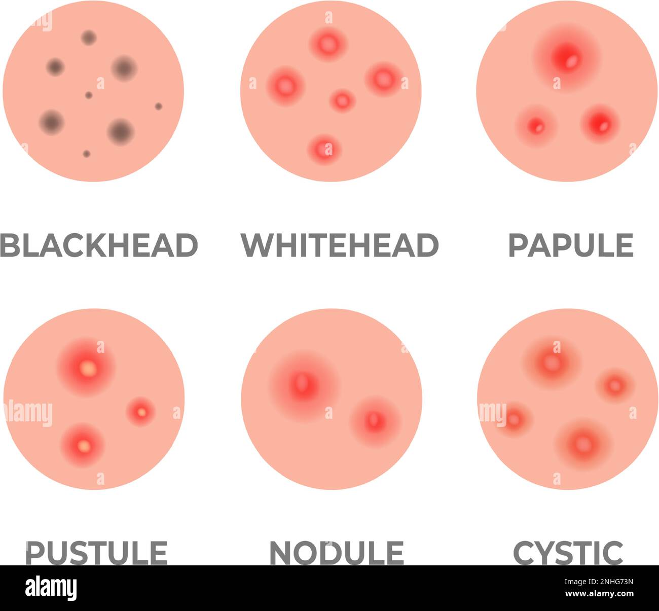 Types of acne illustration. Pimples, skin pores, blackhead, whitehead ...