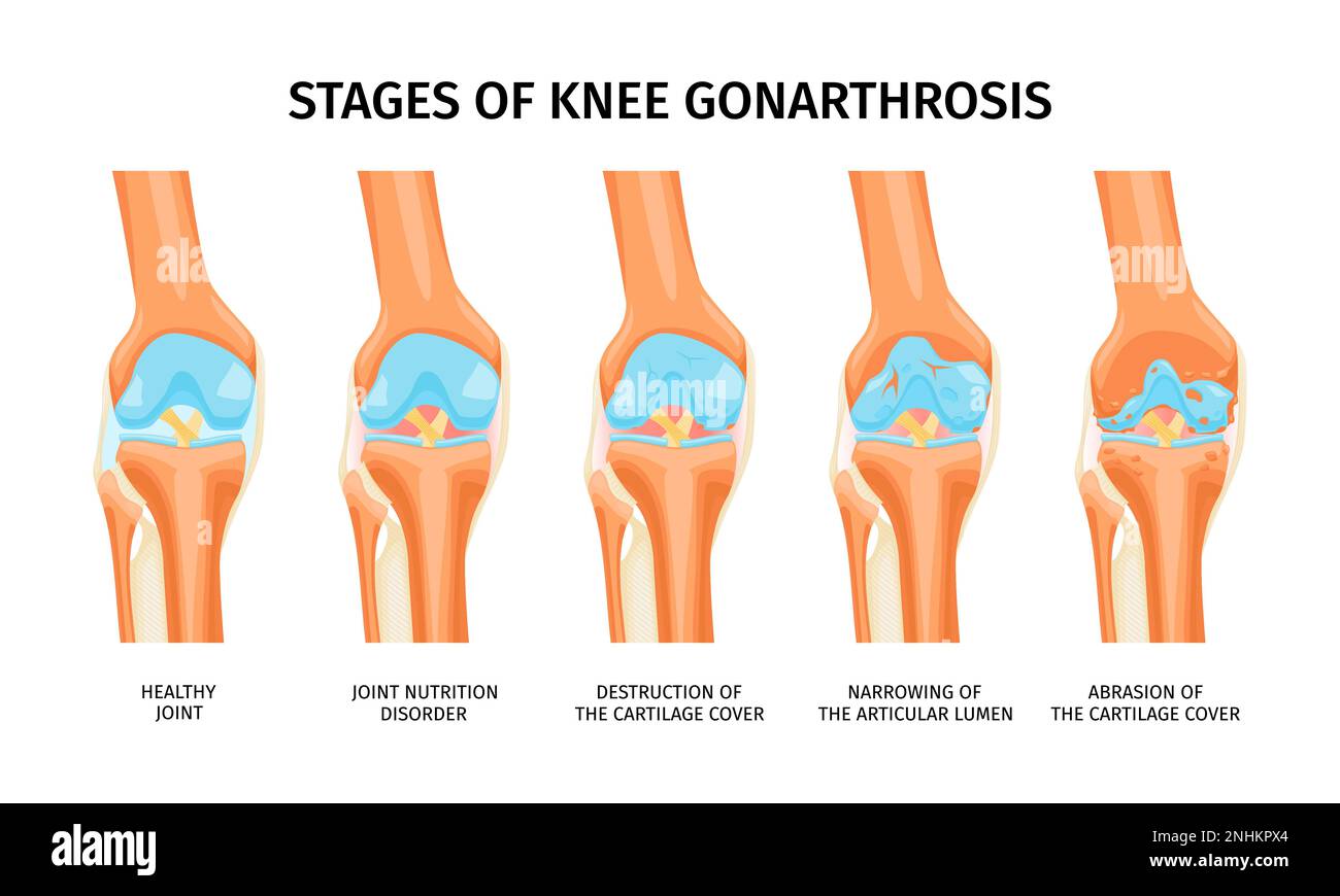 Realistic infographics presenting stages of knee gonarthrosis from