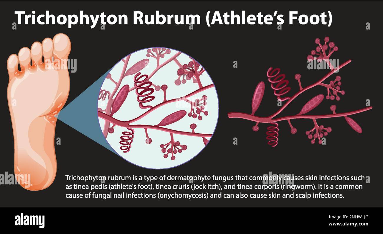 Trichophyton Rubrum fungal infection illustration Stock Vector