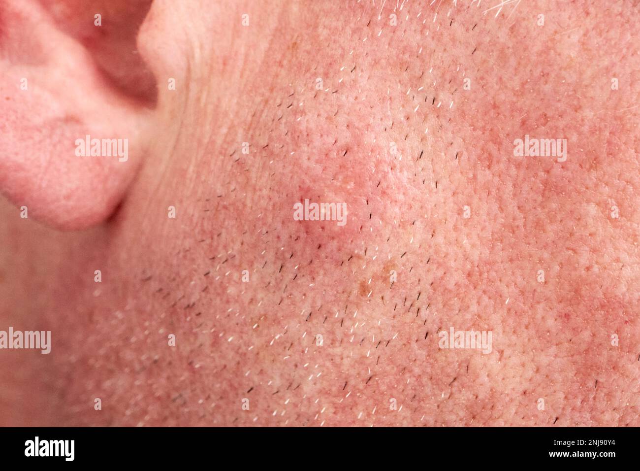mosquito bite swollen up on the side of a mans face Lanzarote, Canary Islands, Spain Stock Photo