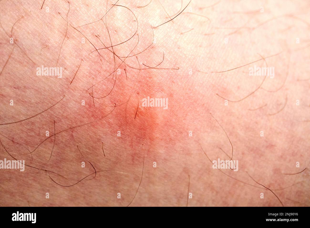 mosquito bite swollen up close up on a leg Lanzarote, Canary Islands, Spain Stock Photo