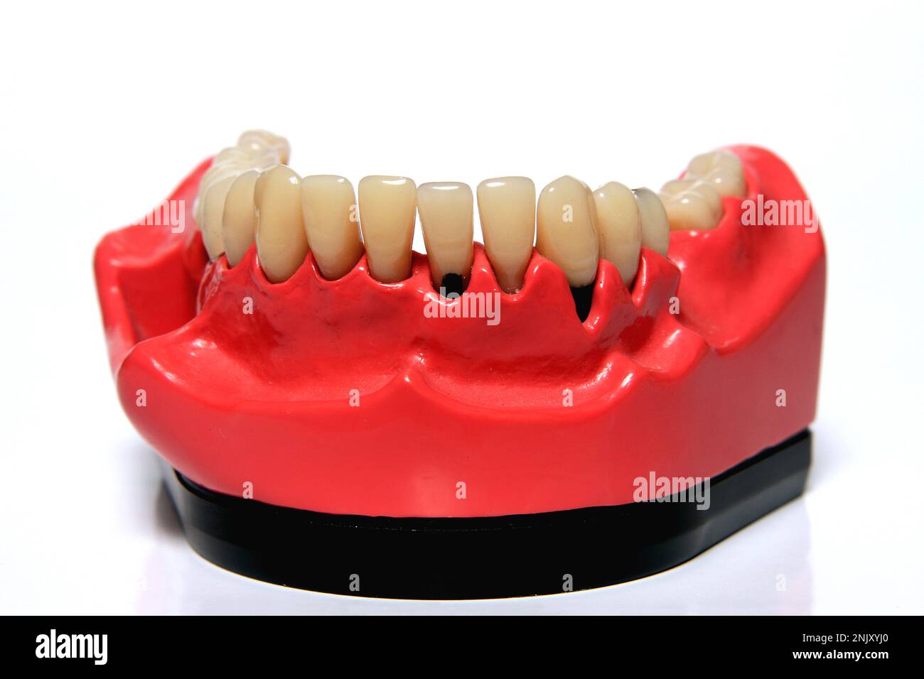 dentition model with caries and periodontitis Stock Photo Alamy