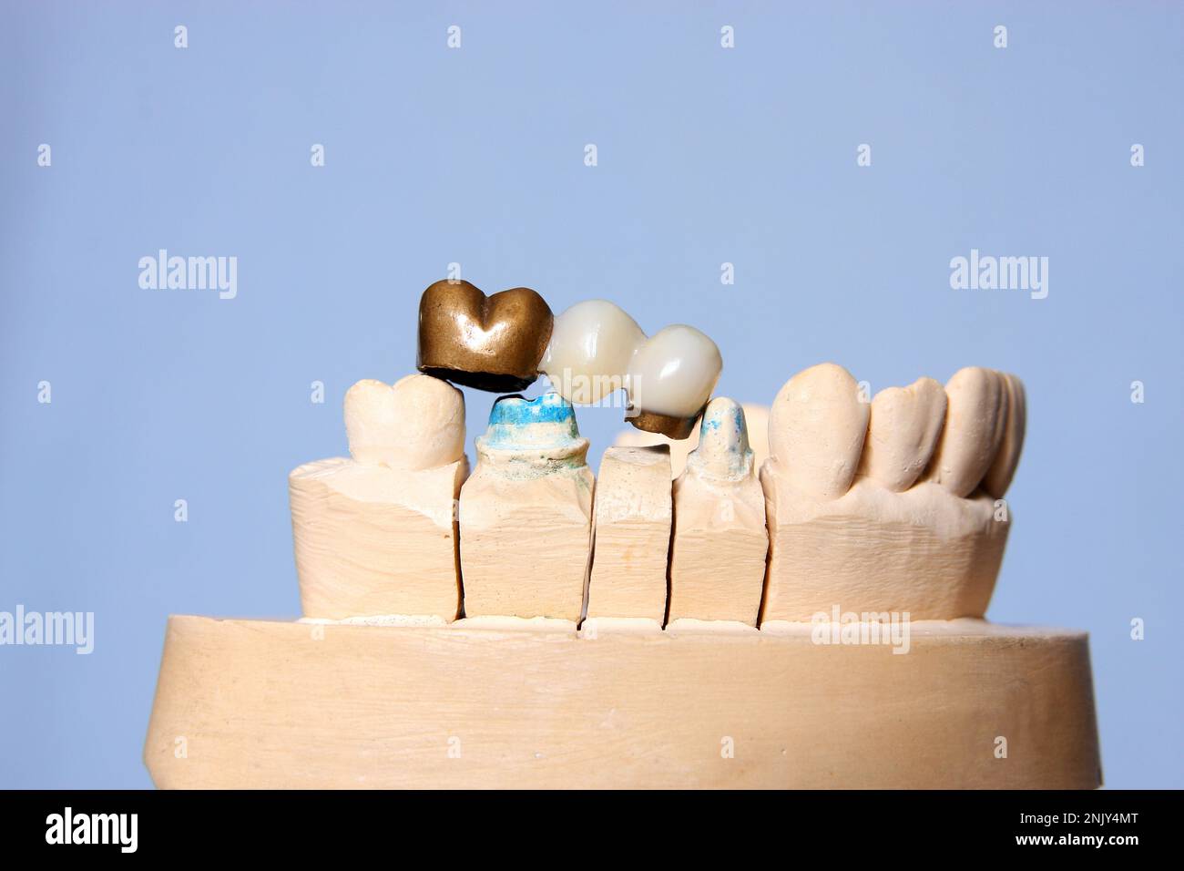 dental bridge on plaster cast Stock Photo Alamy