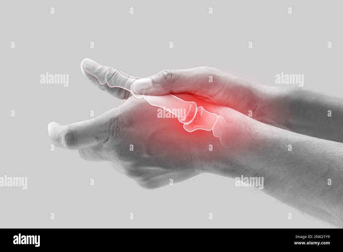 Arthritis of the finger and thumb joint Stock Photo Alamy