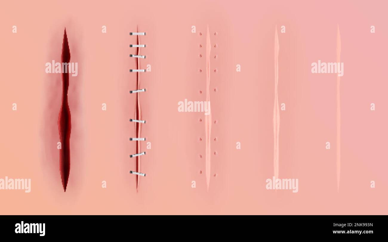 Skin scrape Stock Vector Images - Alamy