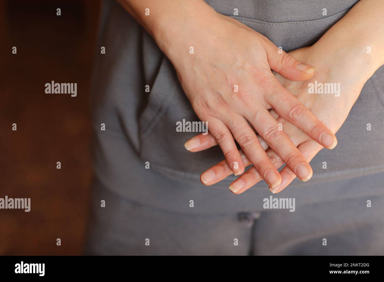 Discolouration of nails after chemotherapy. Hands of cancer patient, skin and nails loss of