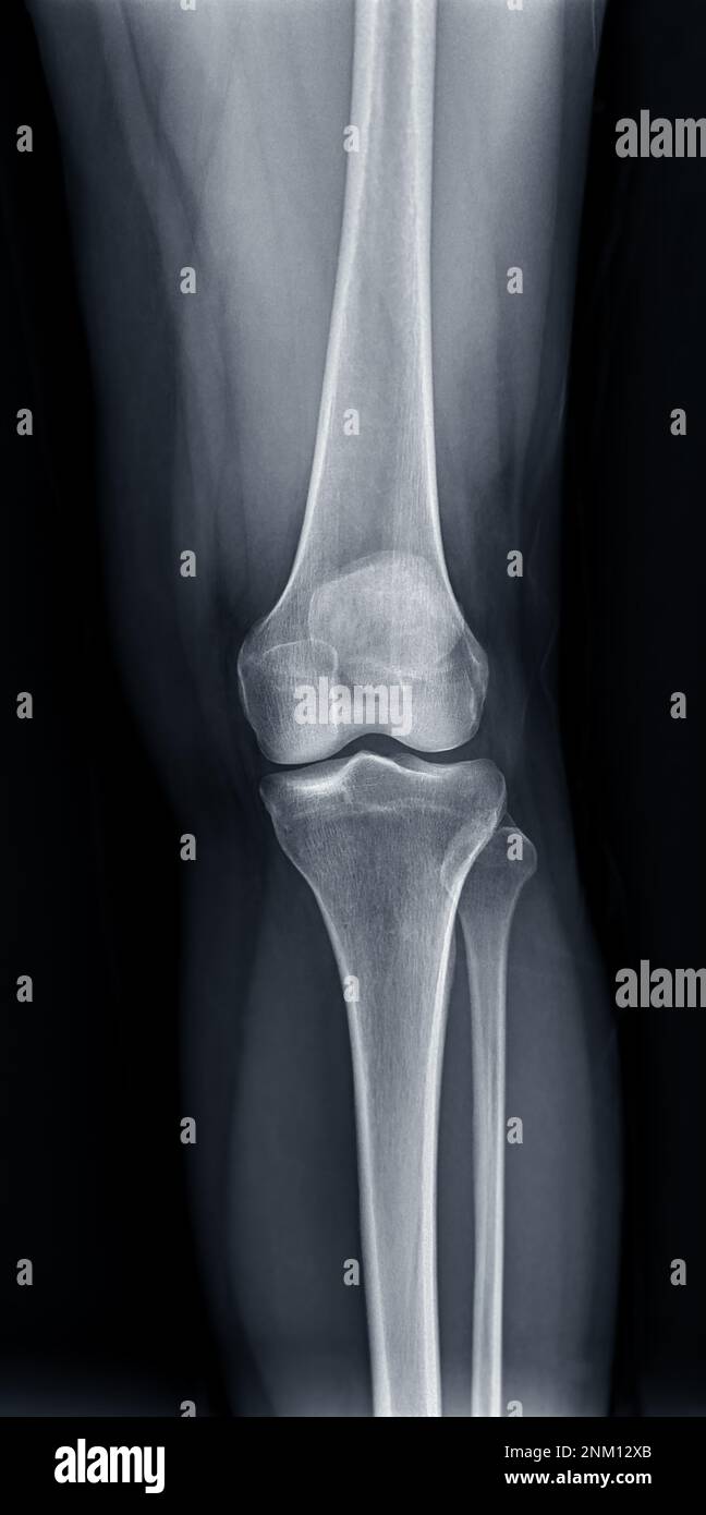 Film xray of Left knee joint AP view for diagnosis knee pain from