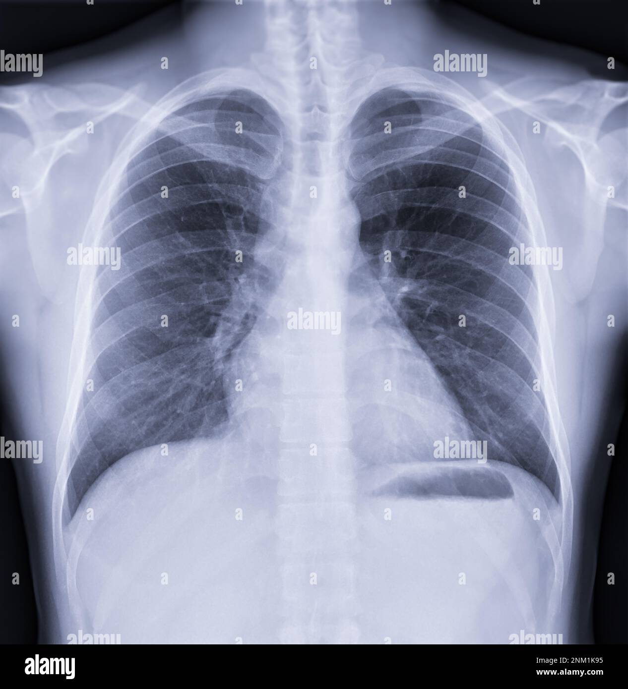 Chest x-ray image , Normal Chest. Stock Photo