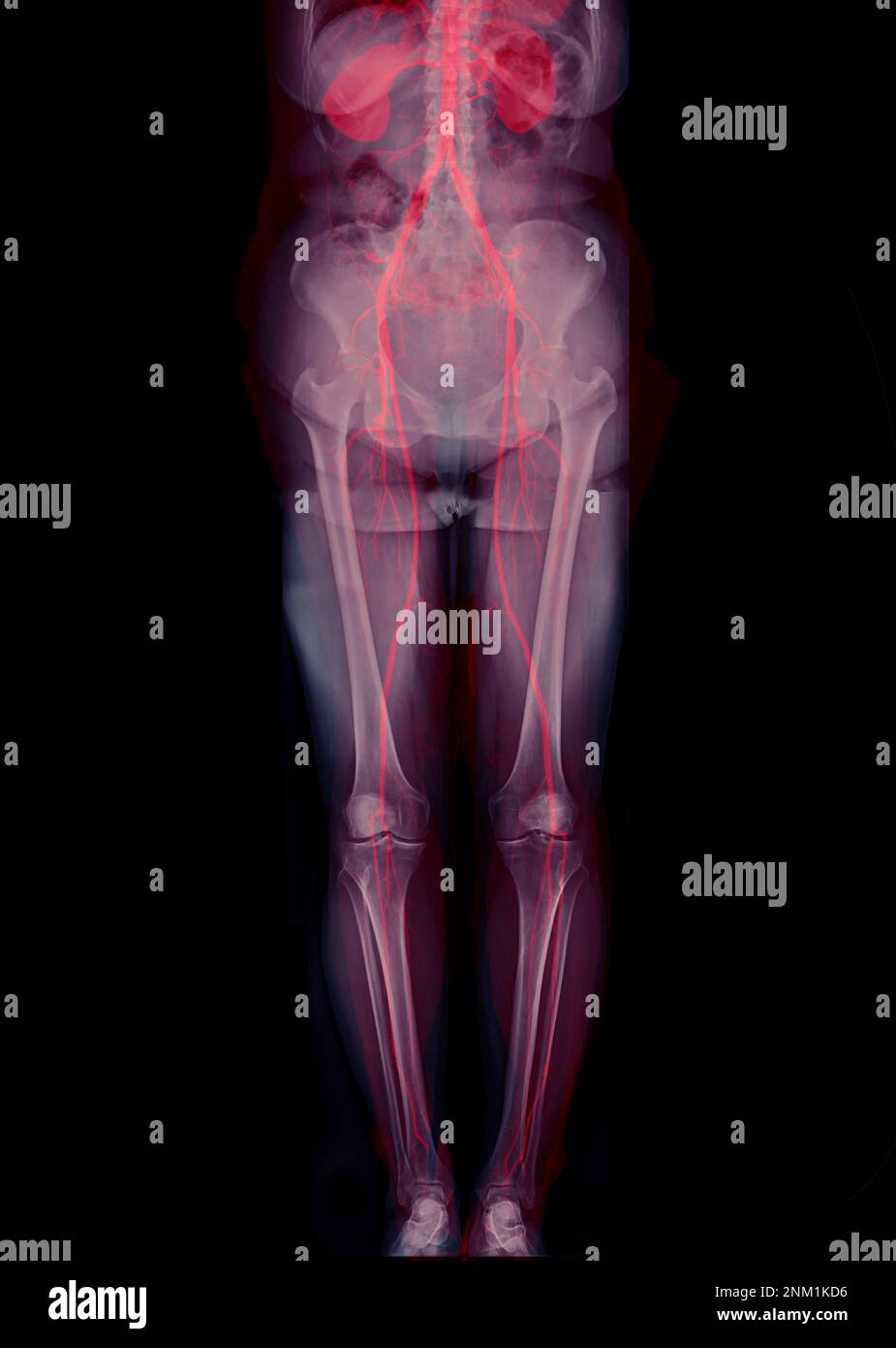 CTA femoral artery run off showing femoral artery for diagnostic Acute