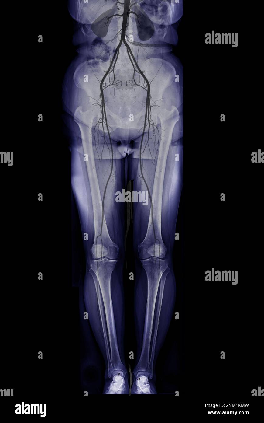 CTA femoral artery run off showing  femoral artery for diagnostic  Acute or Chronic Peripheral Arterial Disease. Stock Photo