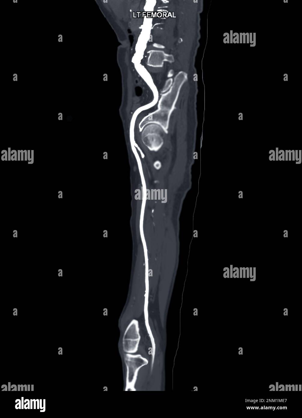 CTA femoral artery run  off MPR curve  showing Left  femoral artery for diagnostic  Acute or Chronic Peripheral Arterial Disease. Stock Photo