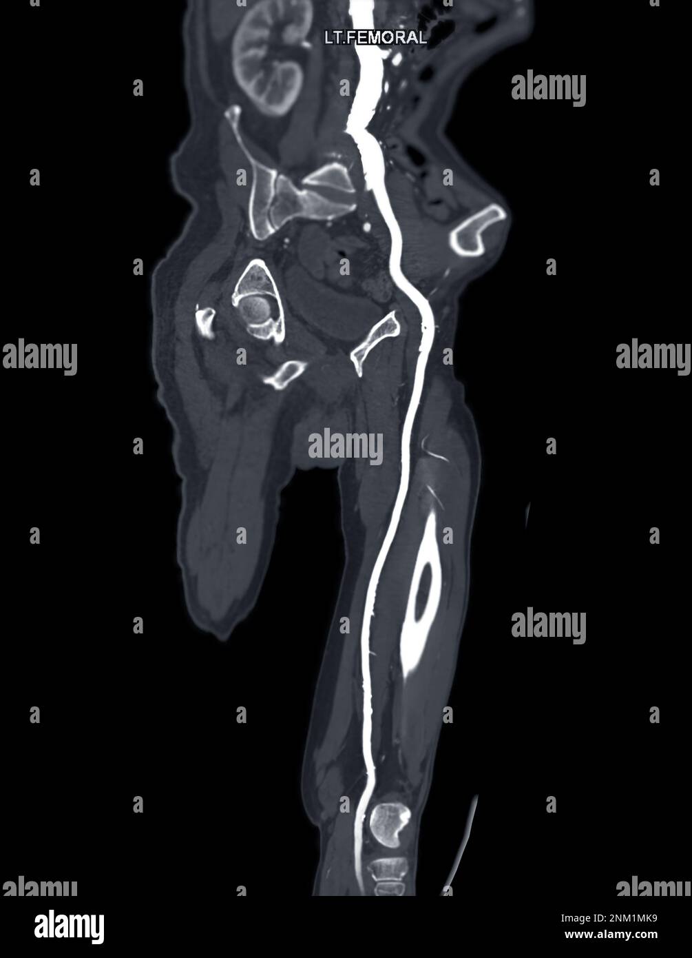 CTA femoral artery run  off MPR curve  showing Left  femoral artery for diagnostic  Acute or Chronic Peripheral Arterial Disease. Stock Photo