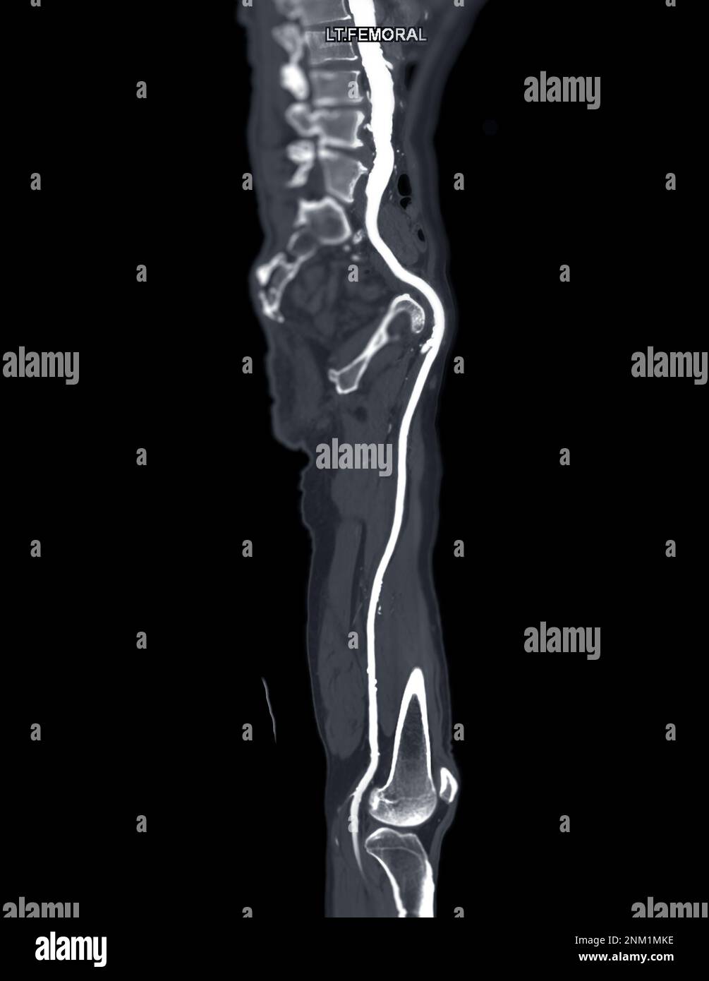 CTA femoral artery run  off MPR curve  showing Left  femoral artery for diagnostic  Acute or Chronic Peripheral Arterial Disease. Stock Photo