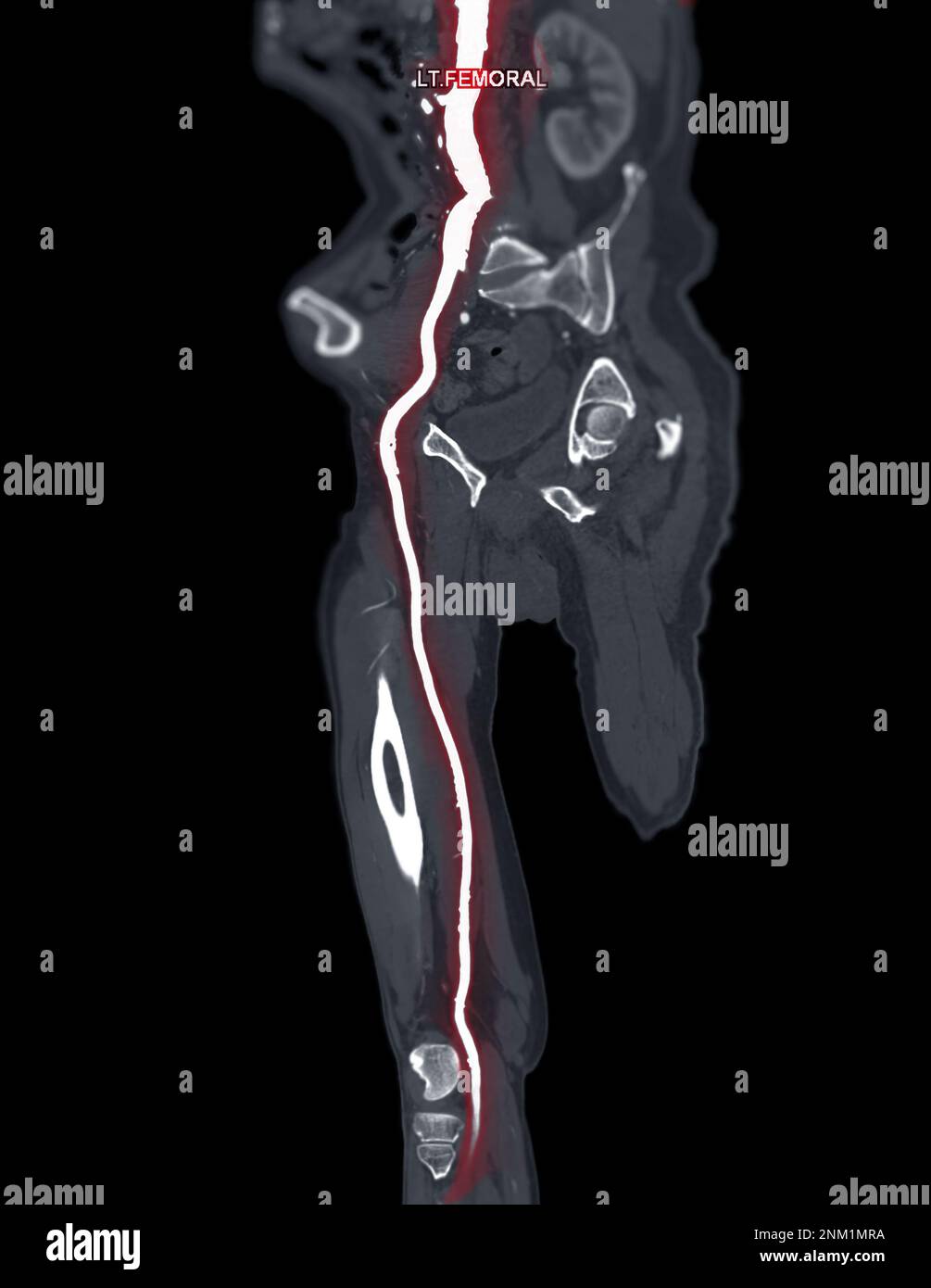 CTA femoral artery run  off MPR curve  showing Left  femoral artery for diagnostic  Acute or Chronic Peripheral Arterial Disease. Stock Photo