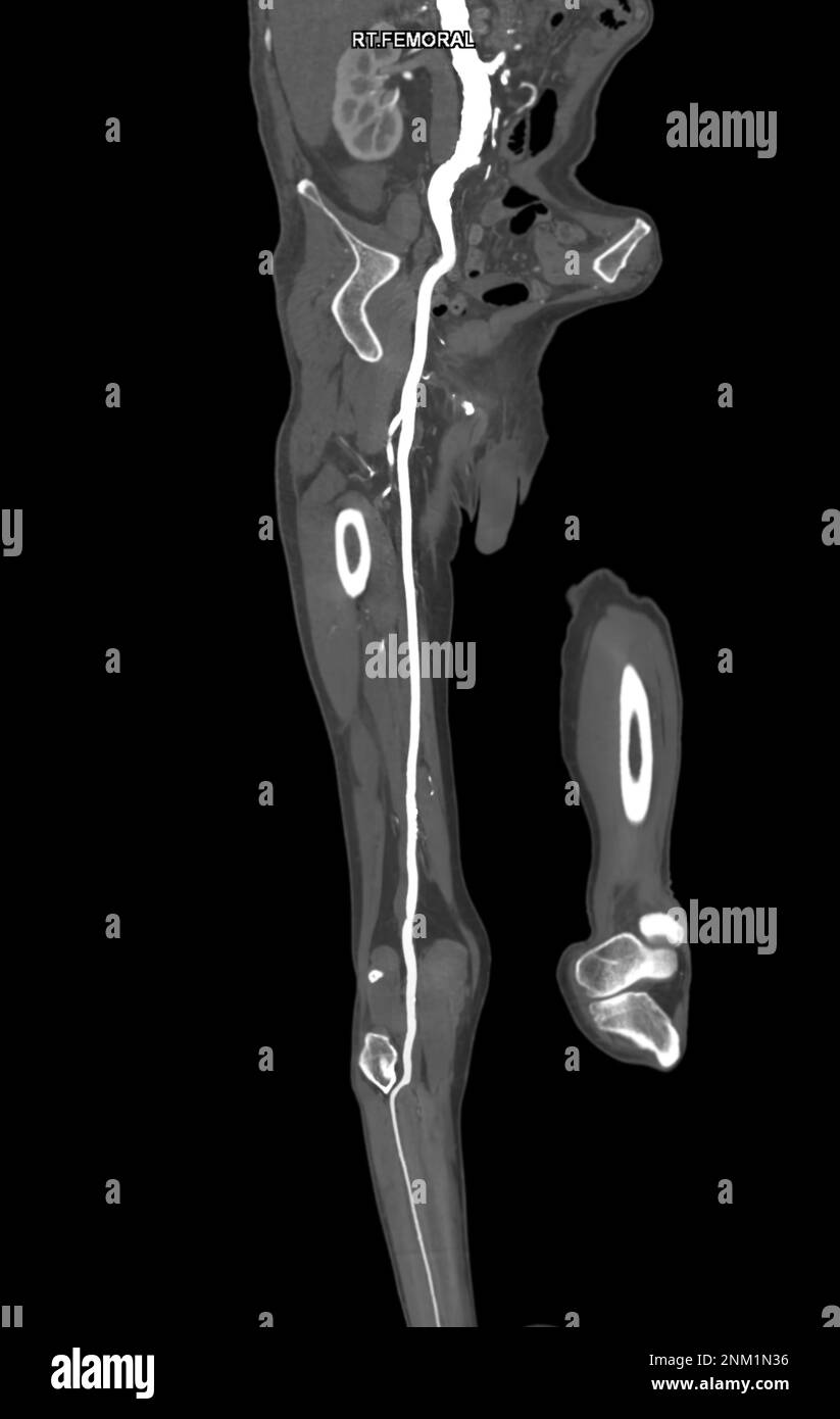 CTA femoral artery run off MPR curve showing Right femoral artery for