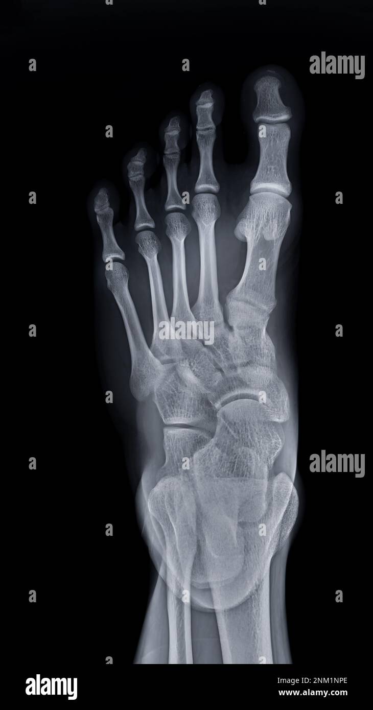 Foot x-ray image AP view  isolated on black background. Stock Photo