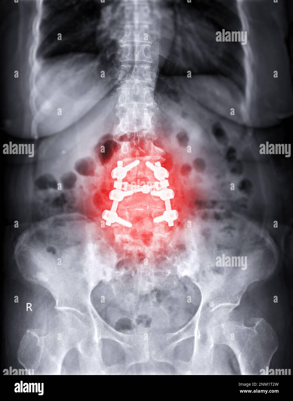 X-ray image of Lumbar spine showing pedicle screw fixation and