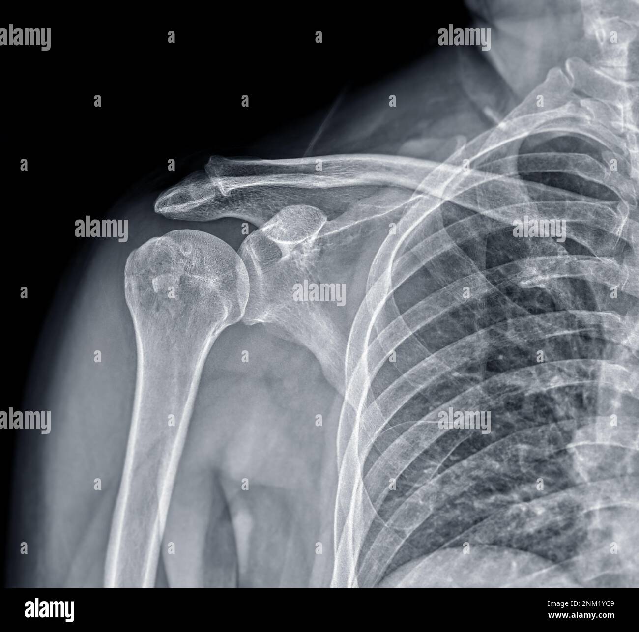 Xray Shoulder joint shoulder front view for diagnosis fracture of shoulder joint Stock Photo