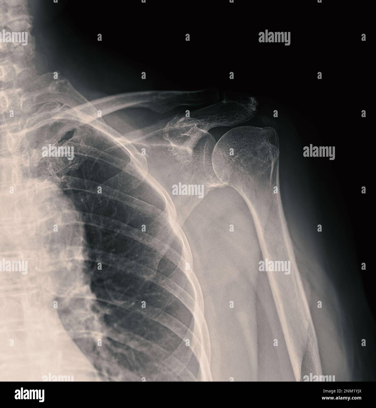 Xray Shoulder joint shoulder front view for diagnosis fracture of