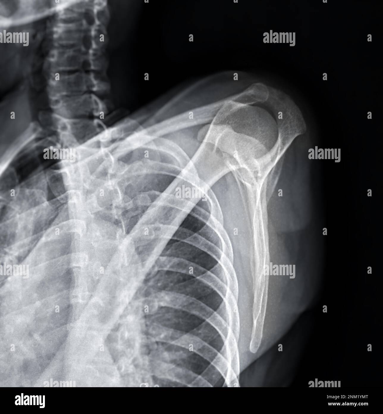 Xray Shoulder joint shoulder transcapular view for diagnosis fracture