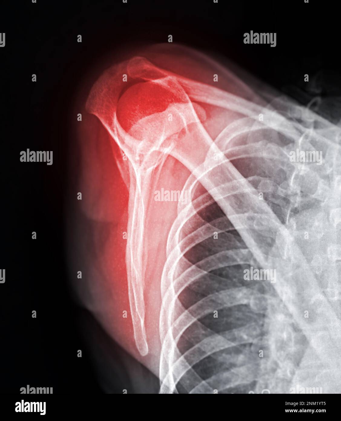 Xray Shoulder joint shoulder transcapular view for diagnosis fracture of shoulder joint Stock