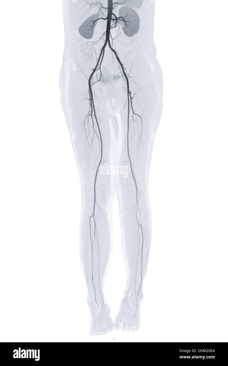 CTA femoral artery run off showing femoral artery  Presenting with Acute or Chronic Peripheral Arterial Disease. Stock Photo