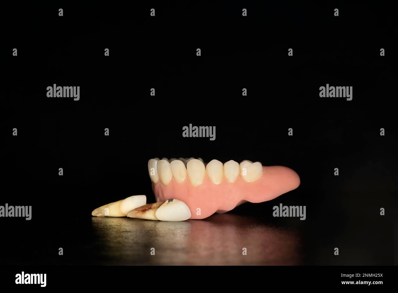 Denture upper jaw made of plastic - Denture Upper Jaw Made Of Plastic With Pulled Teeth Studio Photography With Black Background 2NMH25X