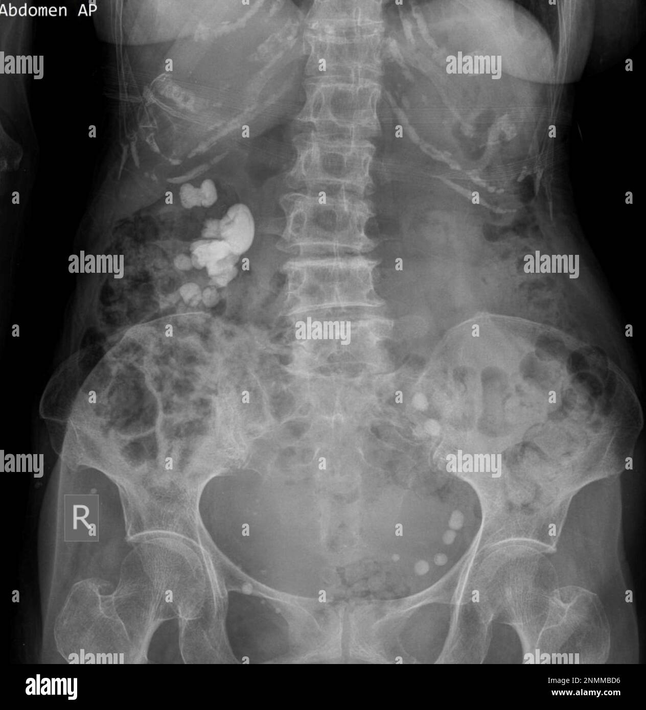 Cystine stones x ray