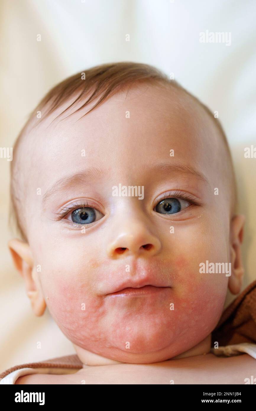 Baby with skin rash around his mouth resulting for a mild food allergy to peanuts Stock Photo