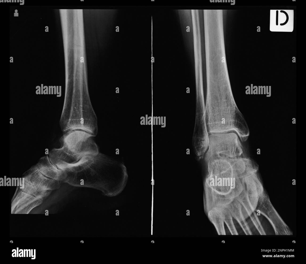 Xray tarsal, ankle and foot Stock Photo Alamy