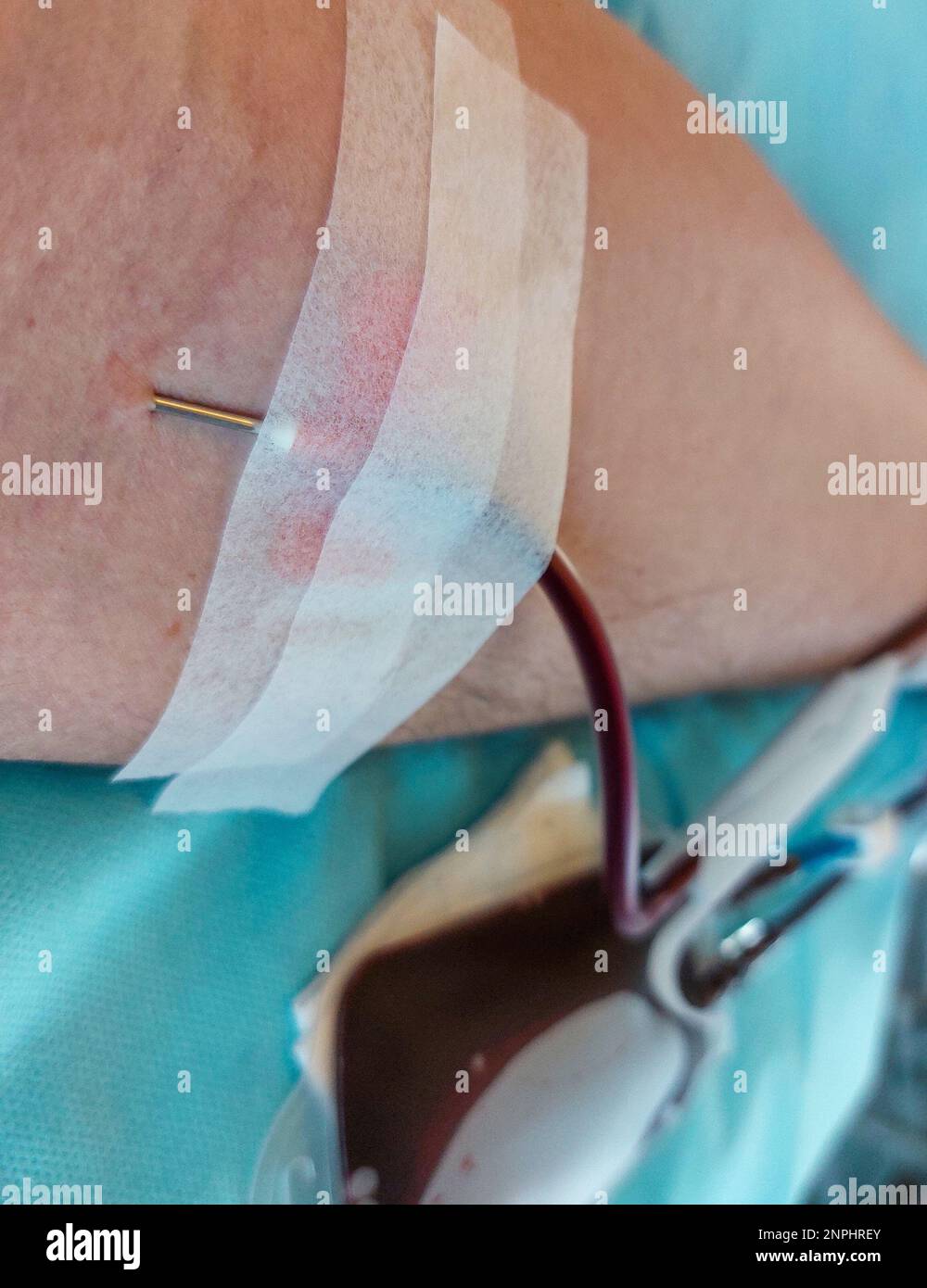 blood donor with big needle stuck in forearm during donation at