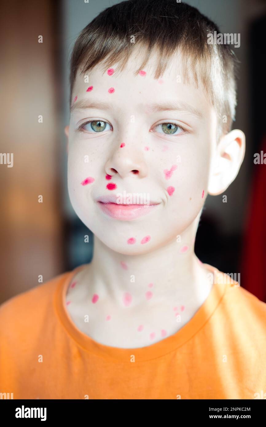 portrait of a 10yearold boy with chickenpox and a rash on his face