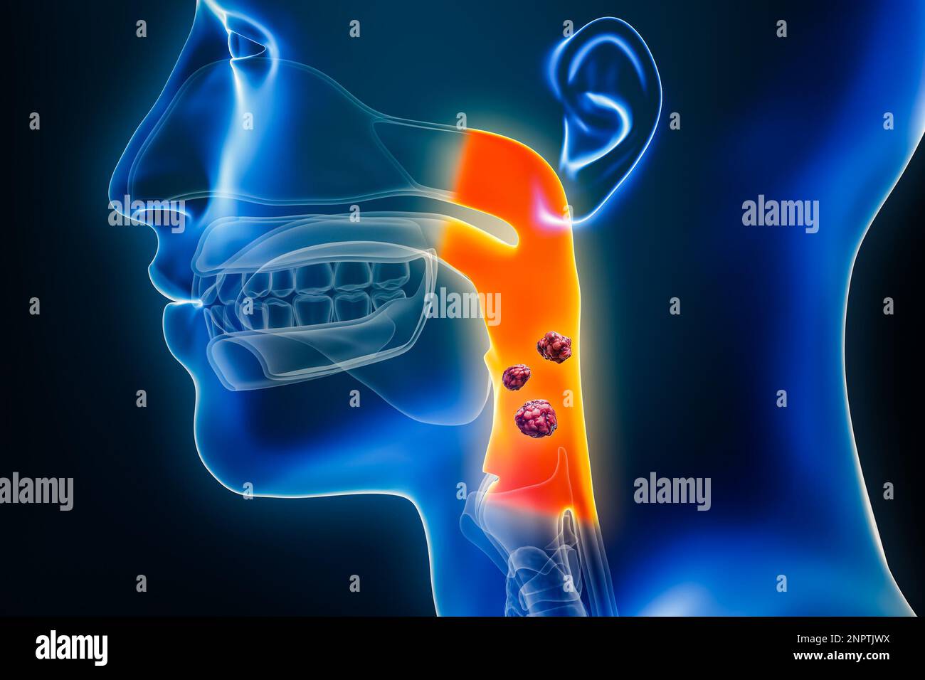 Pharyngeal or throat cancer with organs and tumors or cancerous cells 3D rendering illustration. Anatomy, oncology, pharynx disease, medical, biology, Stock Photo